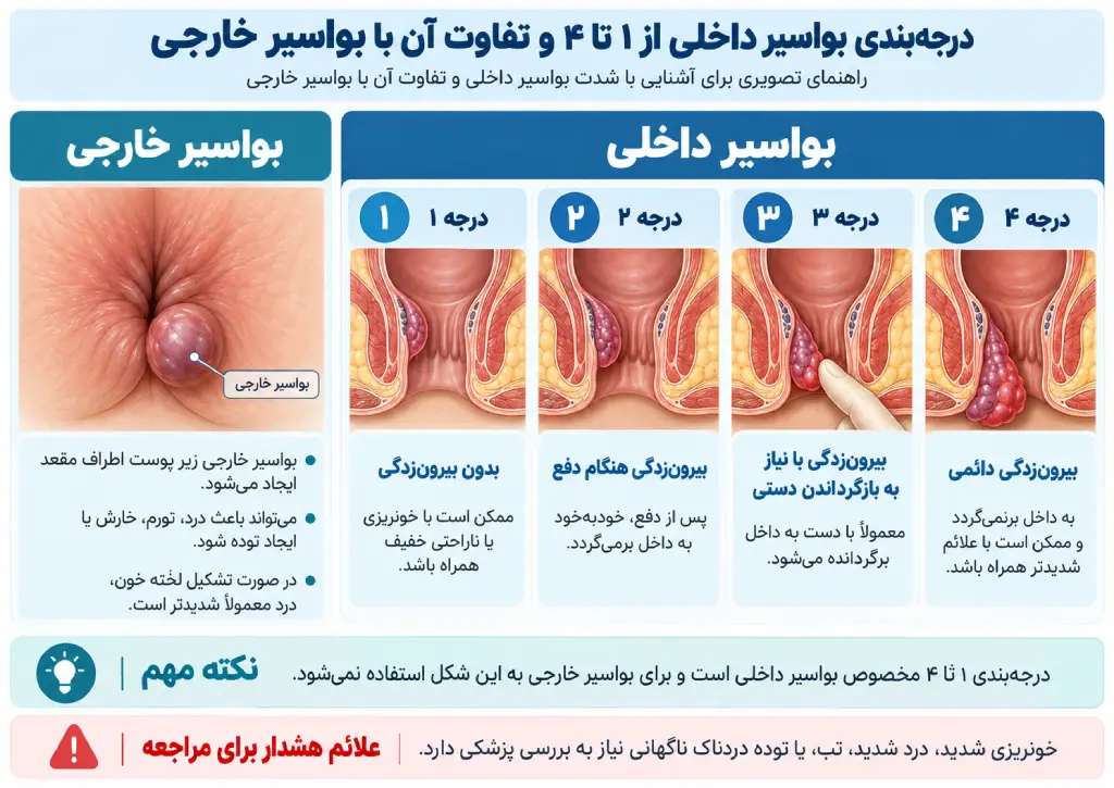 راهنمای تصویری درجات بواسیر