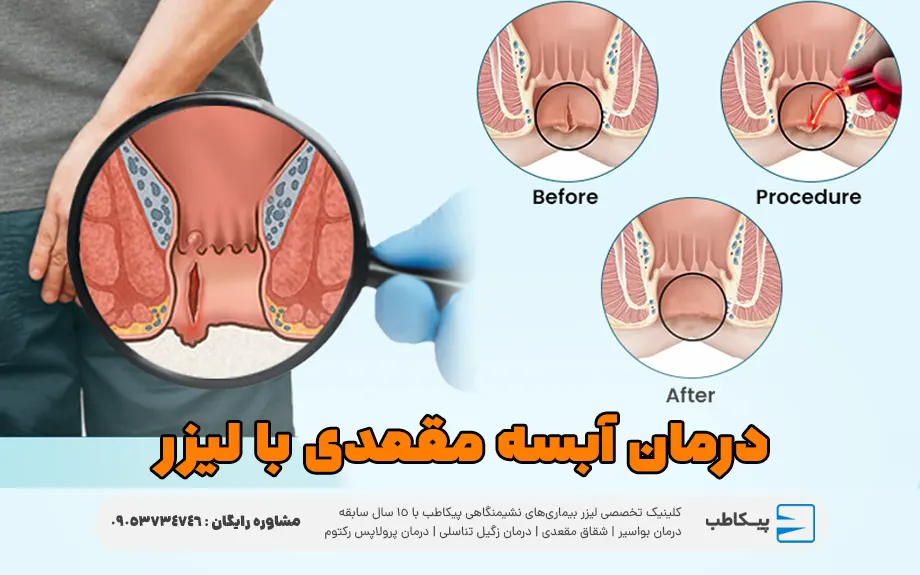 درمان آبسه مقعدی با لیزر