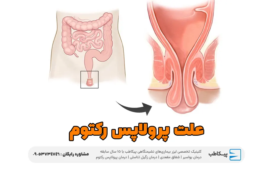 علت پرولاپس رکتوم