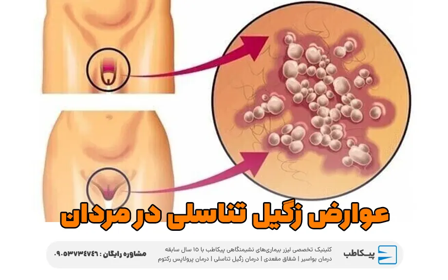 عوارض زگیل تناسلی در مردان