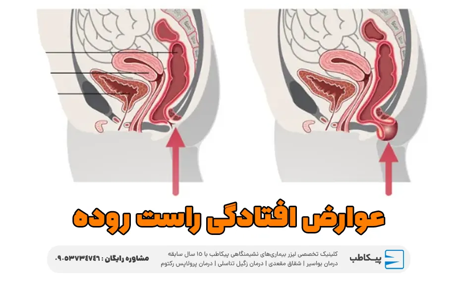 عوارض افتادگی راست روده