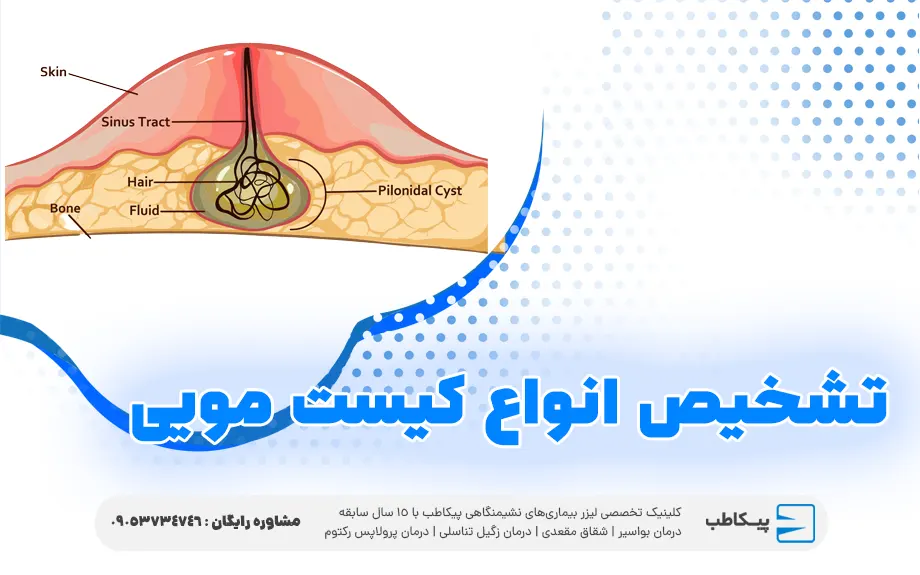 تشخیص انواع کیست مویی