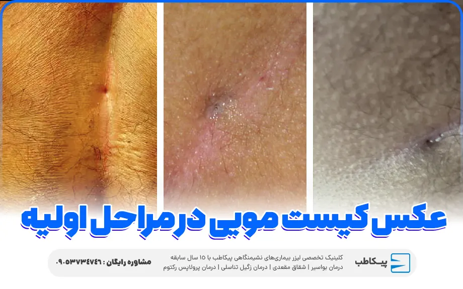 انواع کیست مویی | انواع سینوس پیلونیدال 5 عکس کیست مویی در مراحل اولیه