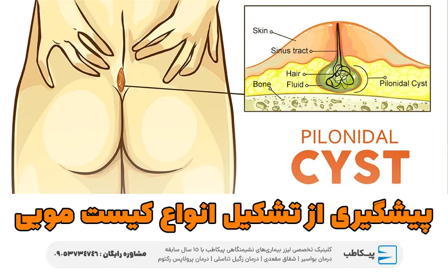 پیشگیری از تشکیل انواع کیست مویی