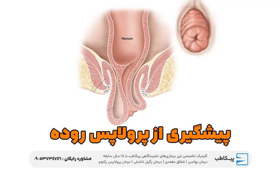 پیشگیری از پرولاپس روده