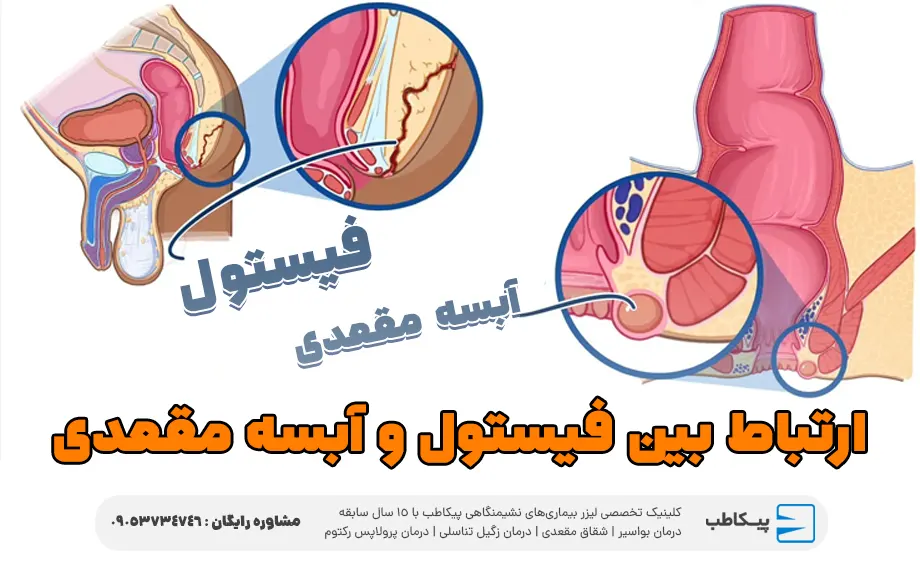 ارتباط بین فیستول و آبسه مقعدی