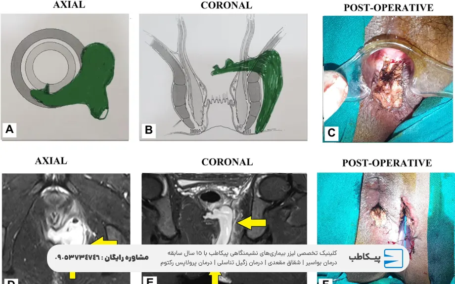 خطرات ابتلا به بیماری فیستول مقعدی