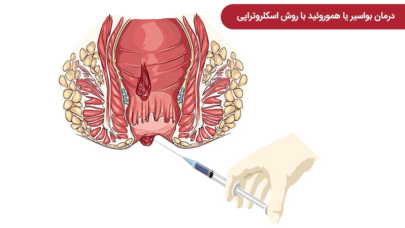 درمان بواسیر با اسکلروتراپی یا تزریق مواد مخصوص
