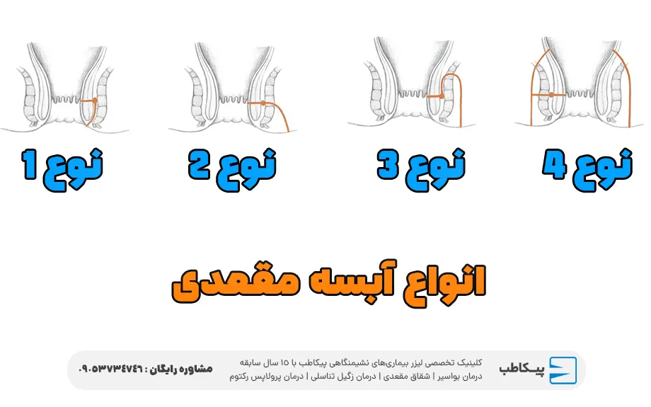 انواع آبسه مقعدی