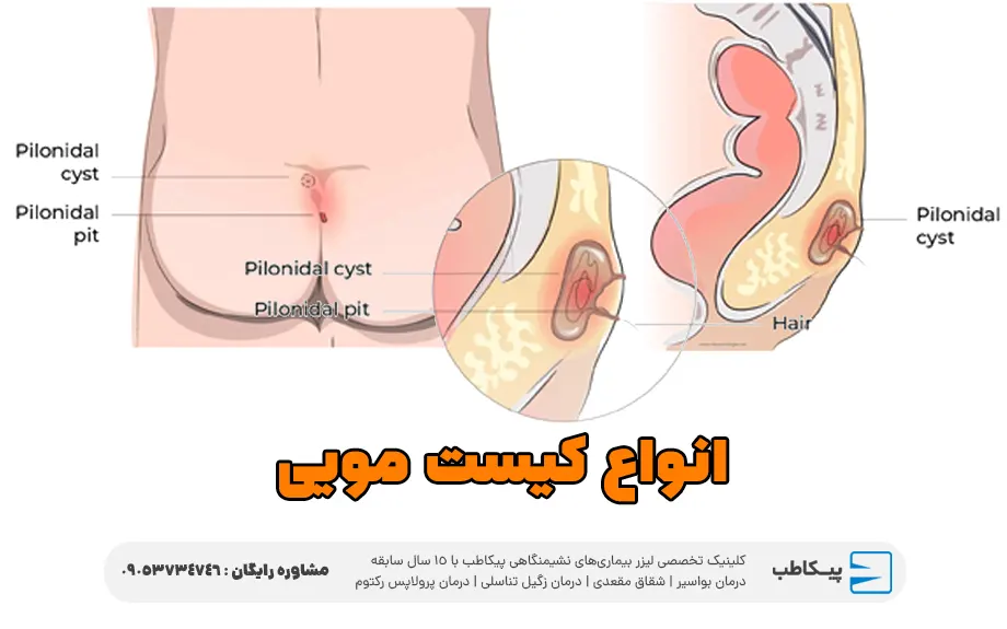 انواع کیست مویی بر مبنای محل تشکیل