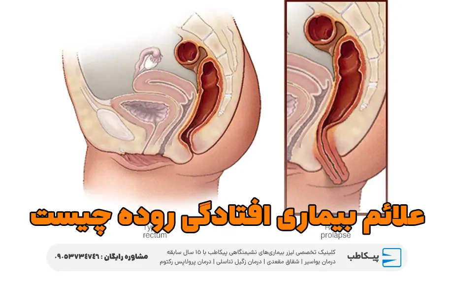 علائم بیماری افتادگی روده چیست