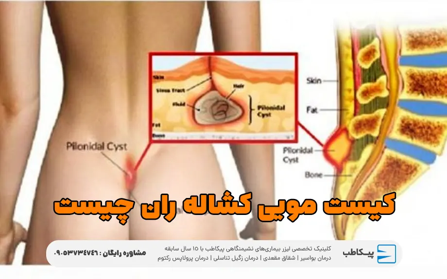 کیست مویی کشاله ران چیست