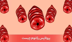 پرولاپس رکتوم