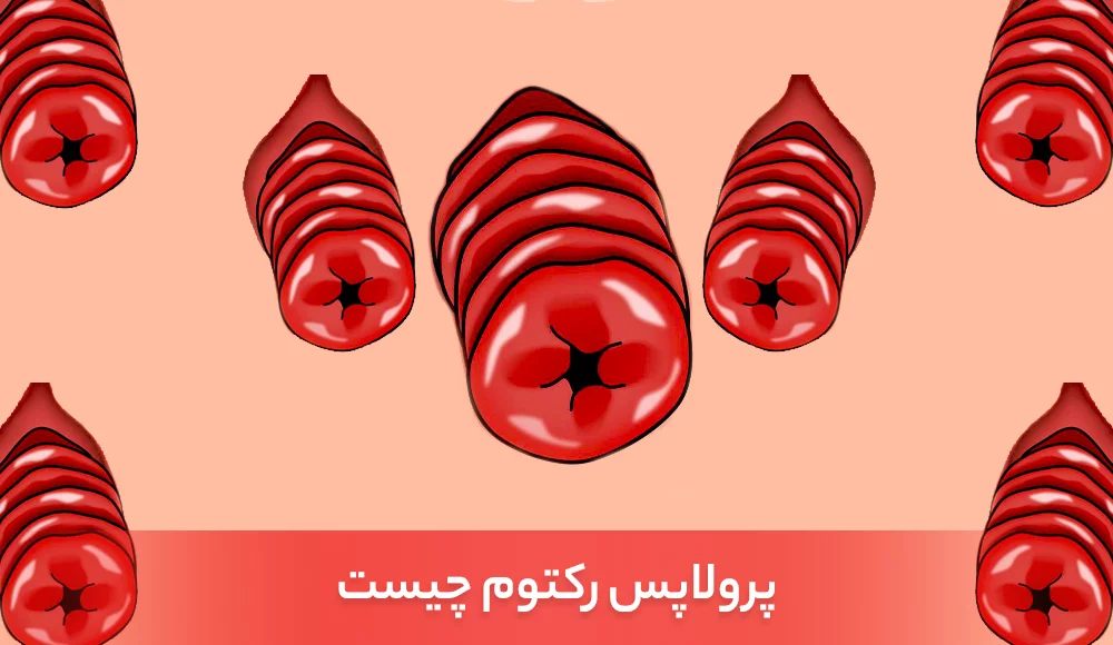 پرولاپس رکتوم