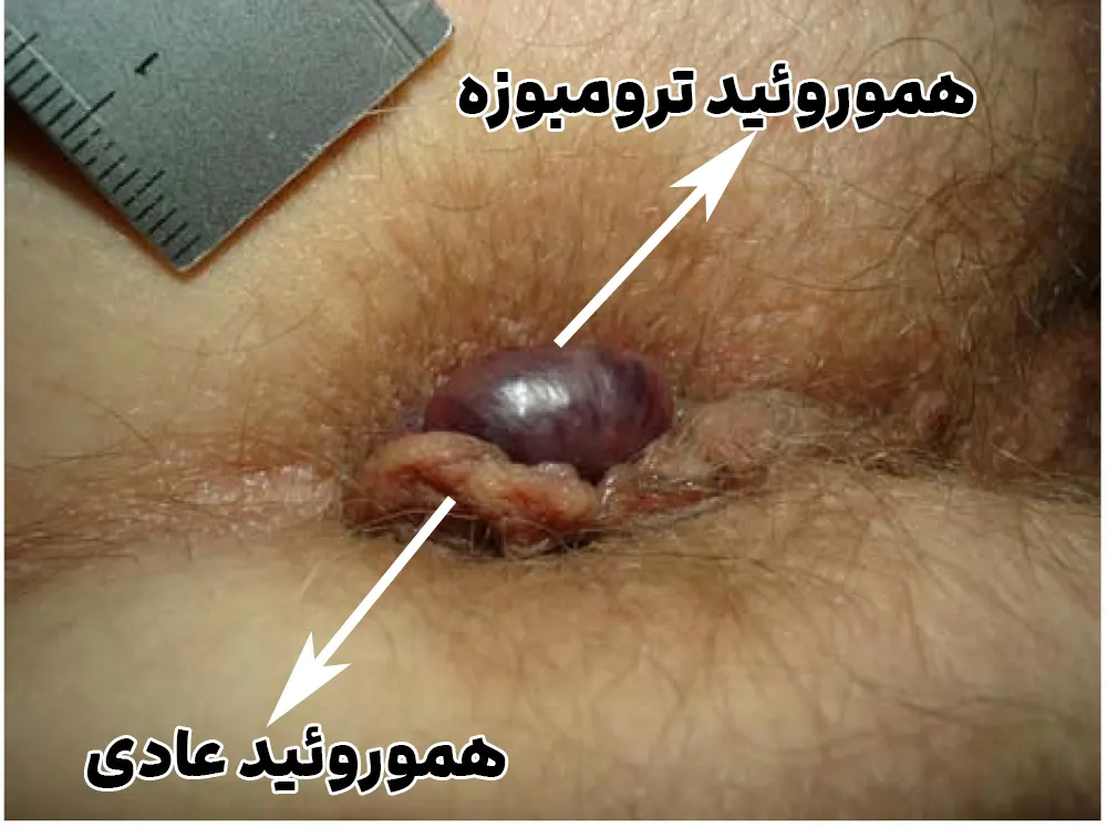 بواسیر خارجی ترومبوزه یا لخته‌شده