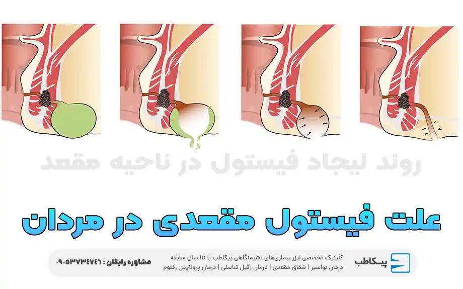 علت فیستول مقعدی در مردان