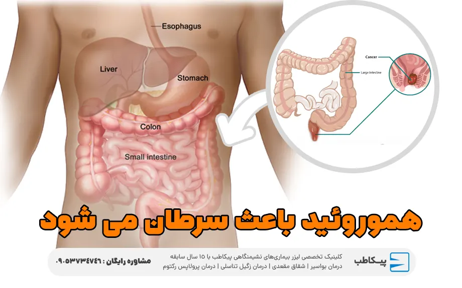 هموروئید در مردان باعث سرطان می شود؟