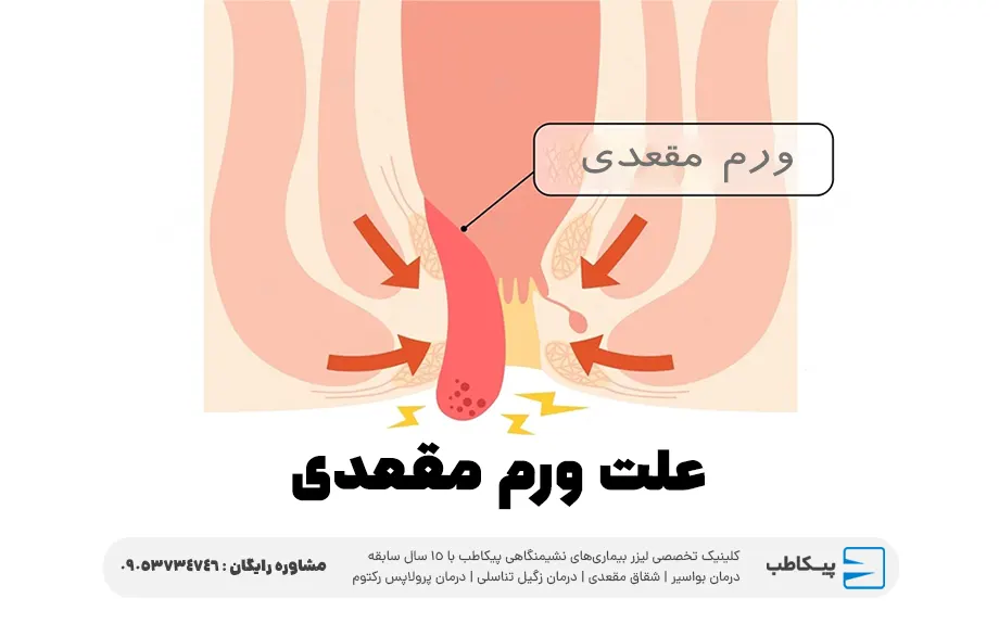 علت ورم مقعدی