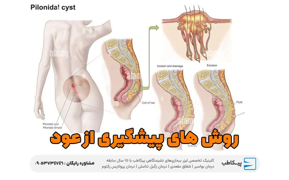 روش های پیشگیری از عود و بازگشت کیست مویی