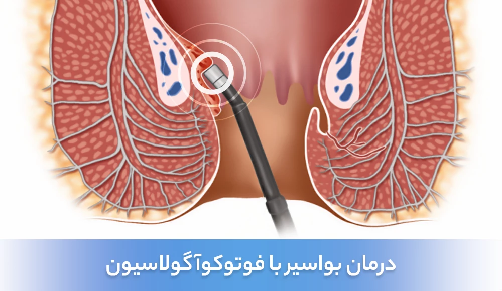 درمان بواسیر با روش فوتوكوآگولاسیون