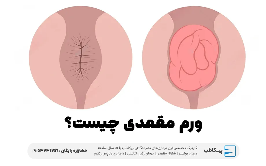 ورم مقعدی چیست؟