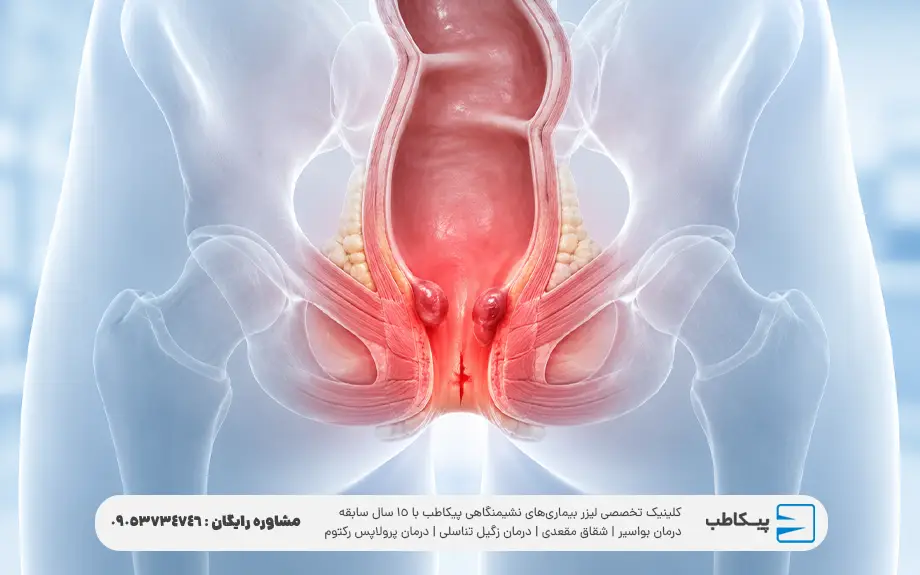 درد مقعدی چیست | علت درد مقعدی در مردان و زنان + درمان 3 علت درد داخل مقعدی