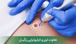 تفاوت لیزر و کرایوتراپی