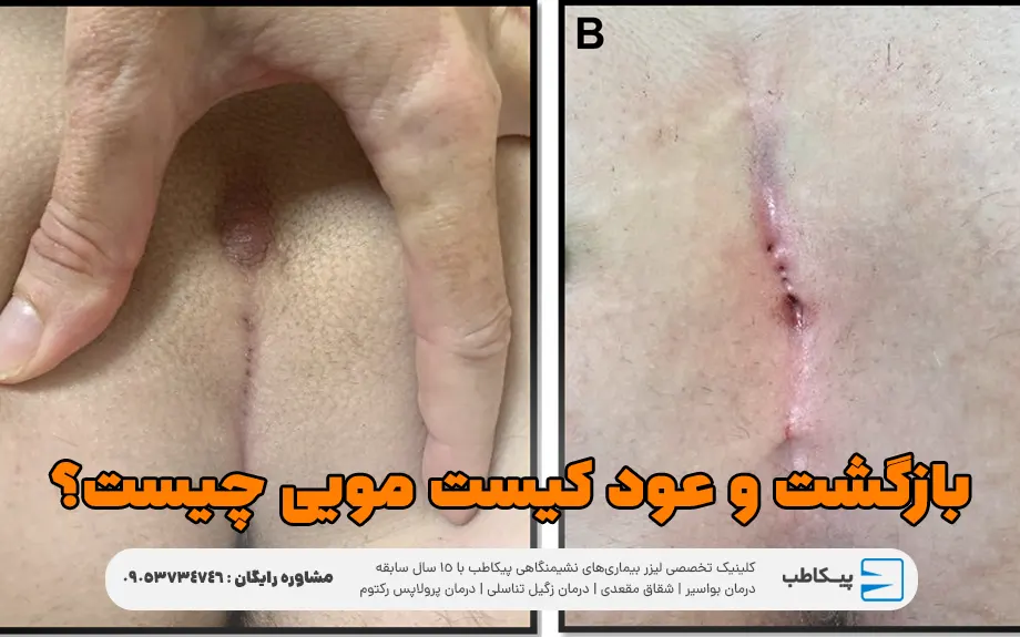 علائم عود و بازگشت کیست مویی