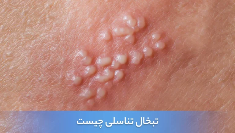 تبخال تناسلی چیست؟