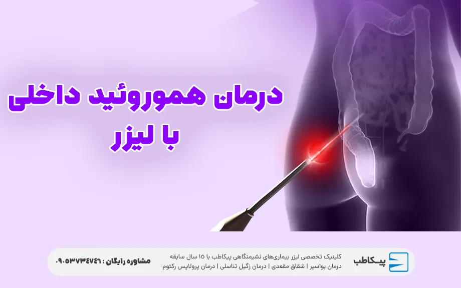 درمان هموروئید داخلی با لیزر