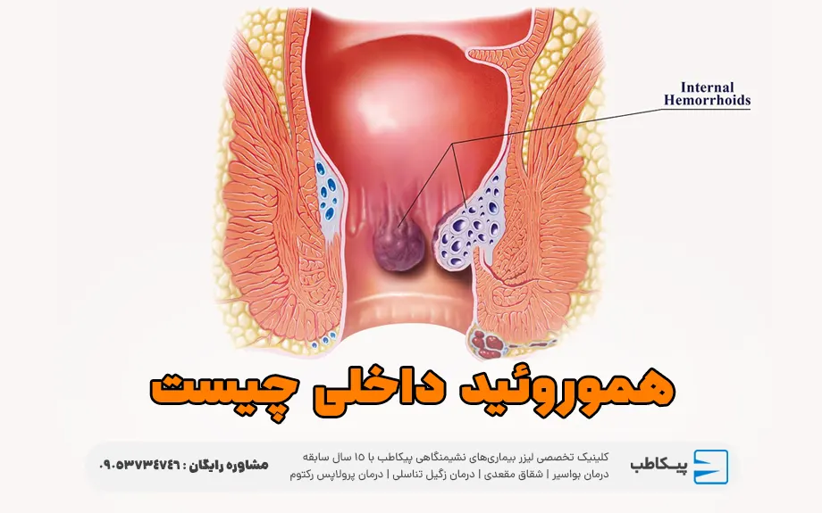 هموروئید داخلی چیست