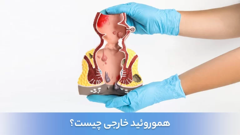 هموروئید خارجی چیست و چه نشانه‌هایی دارد؟