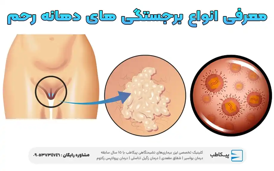 معرفی انواع برجستگی های دهانه رحم و دلایل آن