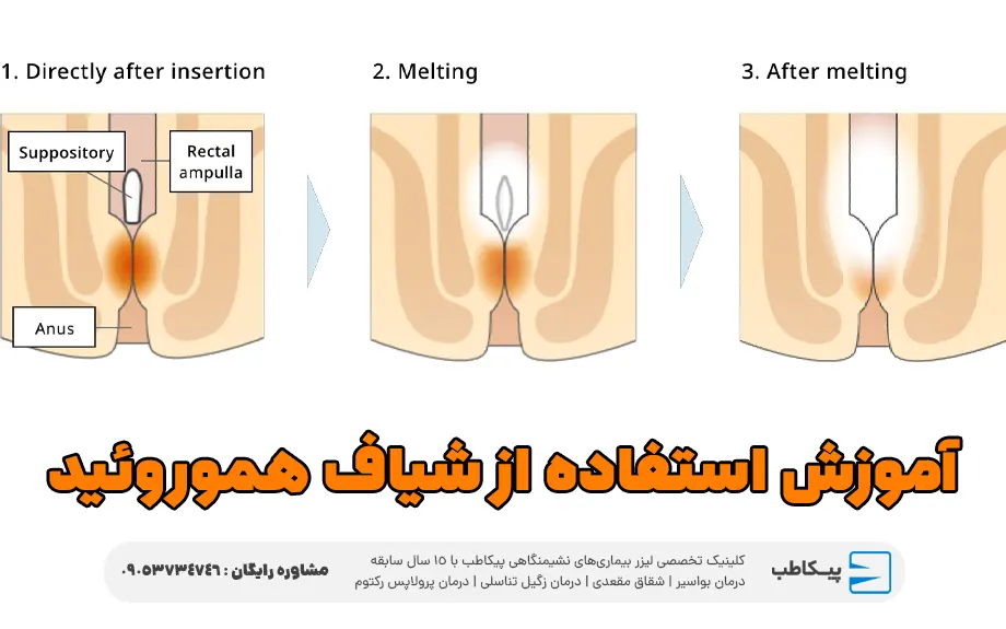 آموزش استفاده از شیاف هموروئید