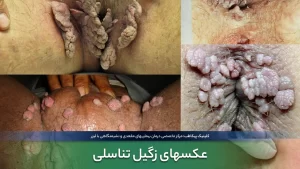 عکسهای زگیل تناسلی در اشکال مختلف (حاوی تصاویر دلخراش و +18)