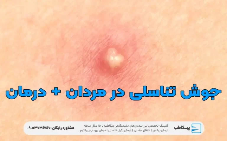 جوش تناسلی در مردان