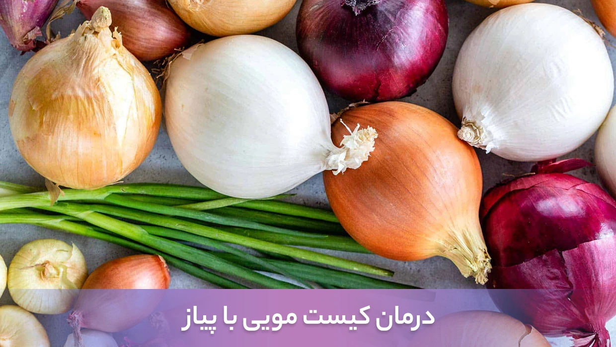 درمان کیست مویی با پیاز