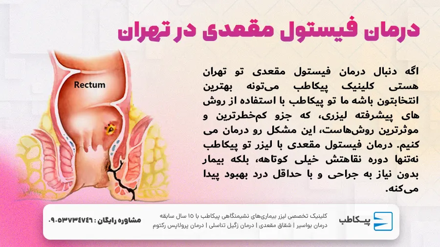 درمان فیستول مقعدی در تهران