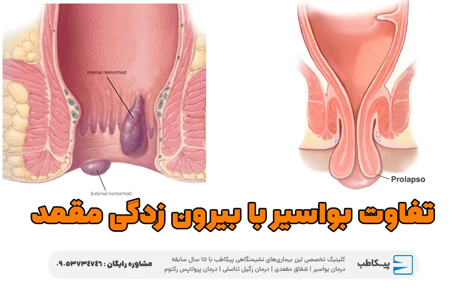 تفاوت بواسیر با بیرون زدگی مقعد