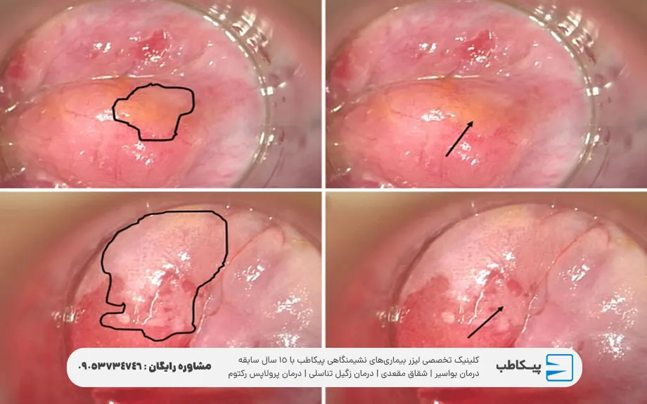 تصاویر و عکس سرطان مقعدی