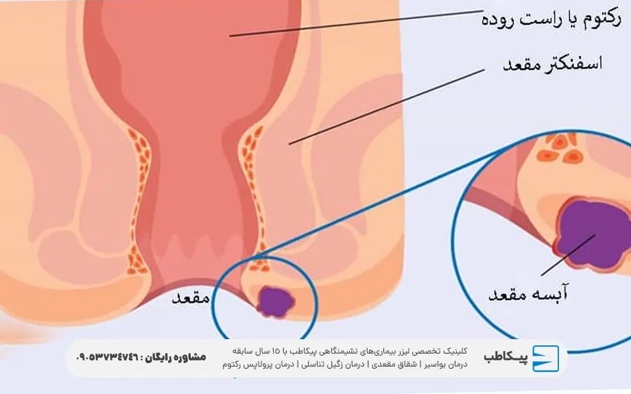 آبسه پری آنال