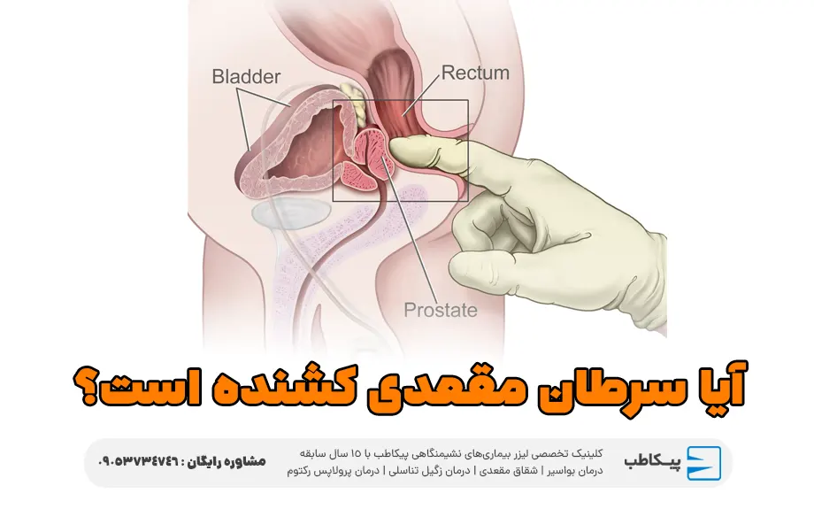 آیا سرطان مقعدی کشنده است؟