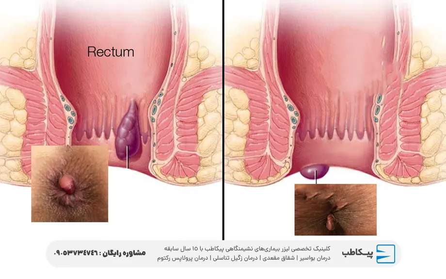 عکس هموروئید ترومبوزه