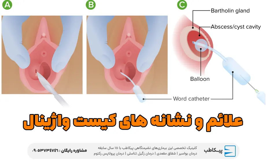 علائم و نشانه های کیست واژینال