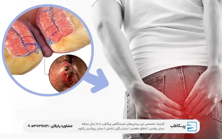 هموروئید ترومبوزه چیست؟ و چگونه درمان می شود