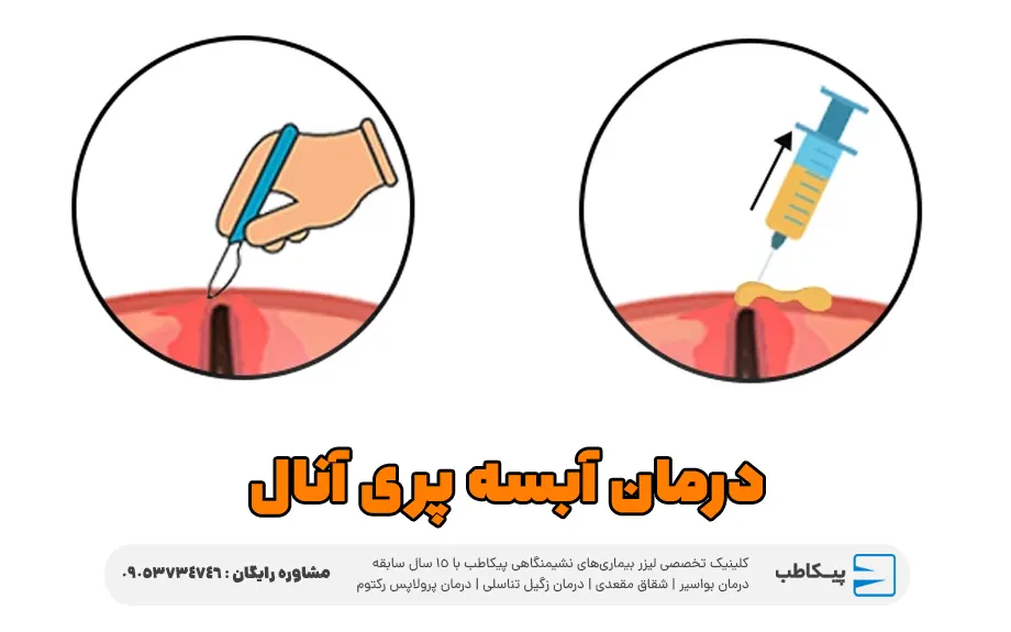 درمان آبسه پری آنال