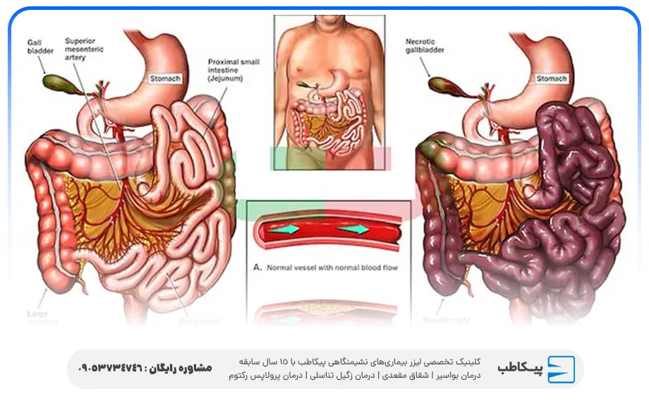 راهنمای جامع ایسکمی روده | تشخیص، درمان و پیشگیری