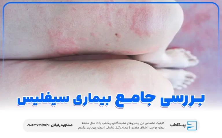 بیماری سیفلیس چیست | علل، علائم و روش های درمان
