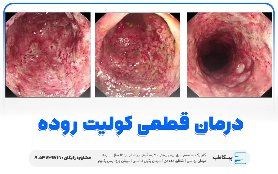 درمان قطعی کولیت روده