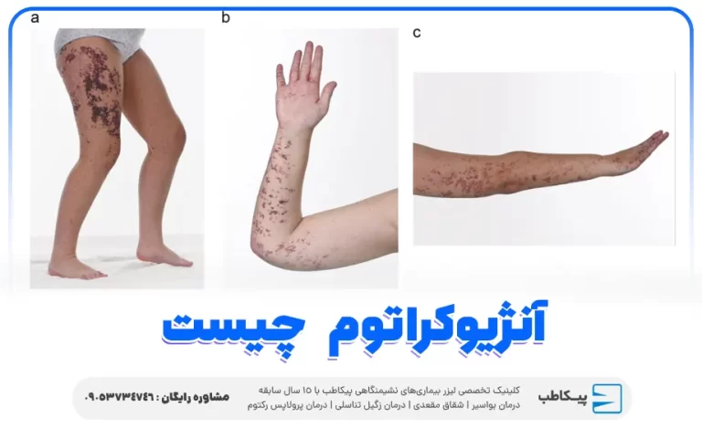 بیماری آنژیوکراتوم چیست و چگونه درمان می شود؟